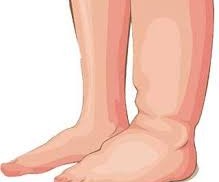 Understanding Swelling in Congestive Heart Failure: Causes, Symptoms, and Management Understanding Swelling in Congestive Heart Failure: Causes, Symptoms, and Management